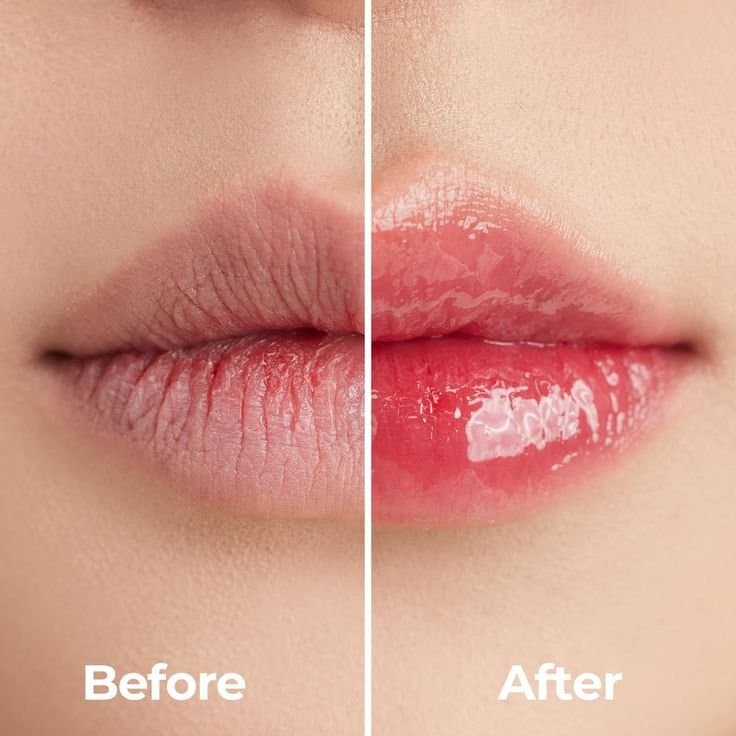 Before and After Lip Pigmentation Reduction