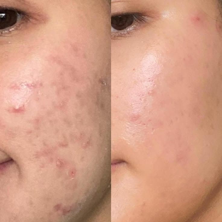 Before and After Radiance & Even Tone